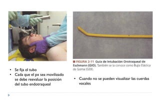 • Se fija el tubo
• Cada que el px sea movilizado
se debe reevaluar la posición
del tubo endotraqueal
• Cuando no se pueden visualizar las cuerdas
vocales
 