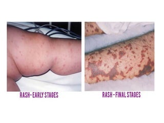 zubairppt-180110161009.pptx fdiagnosis of skin rashes | PPTX