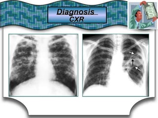 DiagnosisDiagnosis
CXRCXR
 