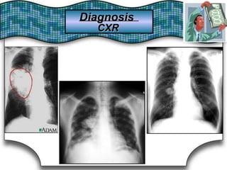 DiagnosisDiagnosis
CXRCXR
 