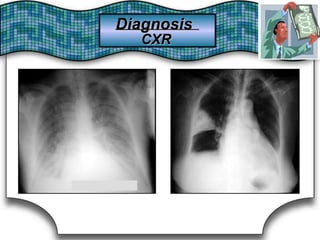 DiagnosisDiagnosis
CXRCXR
 