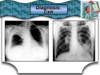 DiagnosisDiagnosis
CXRCXR
 