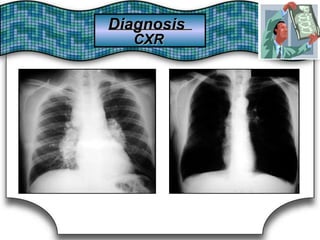 DiagnosisDiagnosis
CXRCXR
 