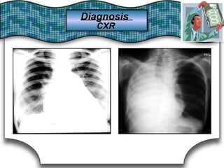 DiagnosisDiagnosis
CXRCXR
 