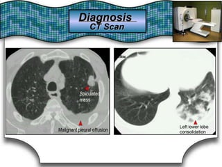 DiagnosisDiagnosis
CT ScanCT Scan
 