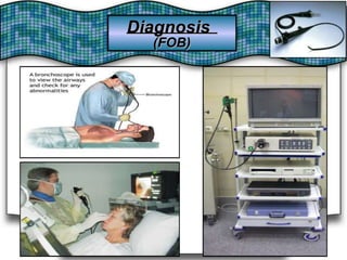 DiagnosisDiagnosis
(FOB)(FOB)
 