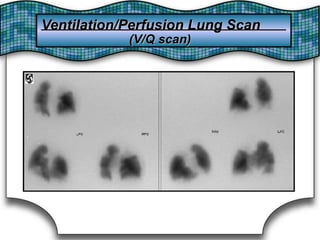 Ventilation/Perfusion Lung ScanVentilation/Perfusion Lung Scan
(V/Q scan)(V/Q scan)
 