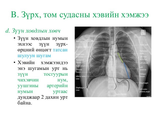 зүрх том судасны дүрс оношлогоо