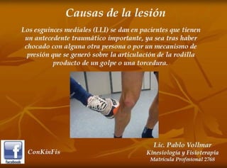 Esguince de Rodilla