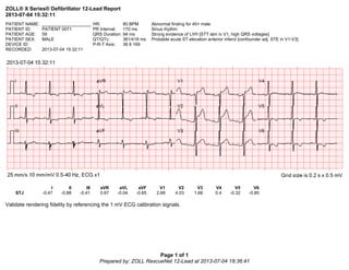 ZOLL® X Series® Defibrillator 12-Lead Report
2013-07-04 15:32:11
Page 1 of 1
Prepared by: ZOLL RescueNet 12-Lead at 2013-07-04 18:36:41
PATIENT NAME: ____________________ HR: 80 BPM Abnormal finding for 40+ male
PATIENT ID: PATIENT 0071 PR Interval: 170 ms Sinus rhythm
PATIENT AGE: 59 QRS Duration: 94 ms Strong evidence of LVH [STT abn in V1, high QRS voltages]
PATIENT SEX: MALE QT/QTc: 361/418 ms Probable acute ST elevation anterior infarct [confounder adj. STE in V1-V3]
DEVICE ID: P-R-T Axis: 36 8 169
RECORDED: 2013-07-04 15:32:11
I II III aVR aVL aVF V1 V2 V3 V4 V5 V6
STJ -0.47 -0.88 -0.41 0.67 -0.04 -0.65 2.68 4.03 1.68 0.4 -0.32 -0.85
Validate rendering fidelity by referencing the 1 mV ECG calibration signals.
 