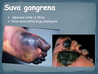  isparava voda iz tkiva
 tkivo suvo,mrke boje,smanjeno
 