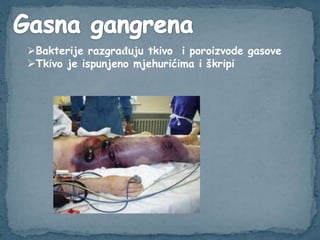 Bakterije razgrađuju tkivo i poroizvode gasove
Tkivo je ispunjeno mjehurićima i škripi
 