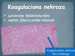  zgrušavanje bjelančevina tkiva
 najčešći faktor je prekid cirkulacije
Koagulacijska nekroza
tkiva bubrega
 