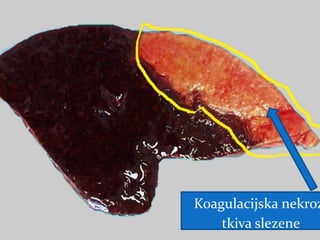 Koagulacijska nekroz
tkiva slezene
 