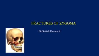 FRACTURES OF ZYGOMA
Dr.Satish Kumar.S
 