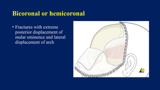 Bicoronal or hemicoronal
• Fractures with extreme
posterior displacement of
malar eminence and lateral
displacement of arch
 