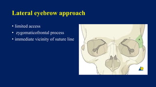 Lateral eyebrow approach
• limited access
• zygomaticofrontal process
• immediate vicinity of suture line
 