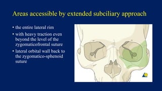 Areas accessible by extended subciliary approach
• the entire lateral rim
• with heavy traction even
beyond the level of the
zygomaticofrontal suture
• lateral orbital wall back to
the zygomatico-sphenoid
suture
 