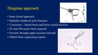 Dingman approach
• Semi closed approach
• Medially displaced arch fractures
• 2 incisions – lateral brow and lower eyelid incision
• ZF and ZM suture lines exposed
• Elevator through upper incision (closed)
• Orbital floor exploration (open)
 