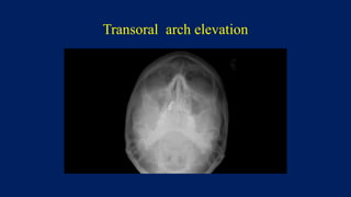 Transoral arch elevation
 