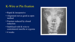 K-Wire or Pin fixation
• Rapid & inexpensive
• Alignment not as good as open
method
• Fracture reduced by closed
reduction
• Stabilised with K-wire to
contralateral maxilla or zygoma
• 4 weeks
 