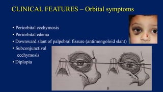 CLINICAL FEATURES – Orbital symptoms
• Periorbital ecchymosis
• Periorbital edema
• Downward slant of palpebral fissure (antimongoloid slant)
• Subconjunctival
ecchymosis
• Diplopia
 