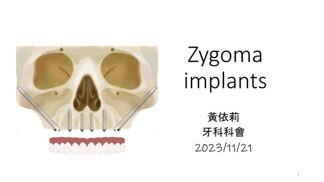 Zygoma implants Zygoma implants Zygoma implants | PPT