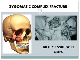 ZYGOMATIC COMPLEX FRACTURE
DR HIMANSHU SONI
OMFS
 