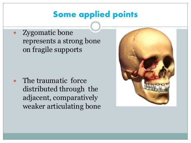 Zygomatic Complex Fracture Zmc