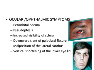 • OCULAR /OPHTHALMIC SYMPTOMS
– Periorbital edema
– Pseudoptosis
– Increased visibility of sclera
– Downward slant of palpebral fissure
– Malposition of the lateral canthus
– Vertical shortening of the lower eye lid
 