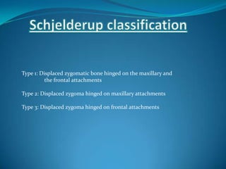 Type 1: Displaced zygomatic bone hinged on the maxillary and
the frontal attachments
Type 2: Displaced zygoma hinged on maxillary attachments
Type 3: Displaced zygoma hinged on frontal attachments
 