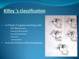 a) # of body of zygoma involving orbit
a) Min displacement
b) Inward & downward
c) Inward & posterior
d) Outward
e) communited
b) # of arch Without orbit involvement
 