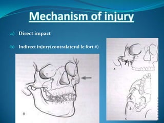a) Direct impact
b) Indirect injury(contralateral le fort #)
Mechanism of injury
 