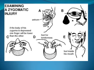 Inspection Palpation
Laceration
Symmetry
Pupillary levels
Periorbital edema
Periorbital ecchymosis
Tenderness
Malar depression
crepitus
 