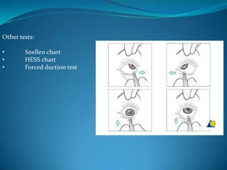 Other tests:
• Snellen chart
• HESS chart
• Forced duction test
 