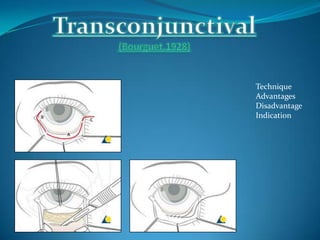 Technique
Advantages
Disadvantage
Indication
 