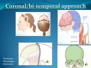 Technique
Advantages
Indication
 