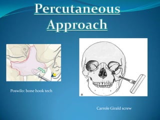 Poswilo: bone hook tech
Carrole Girald screw
 
