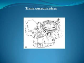 Trans -osseous wires
 