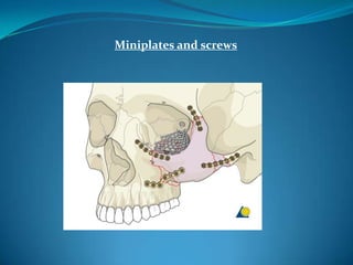 Miniplates and screws
 