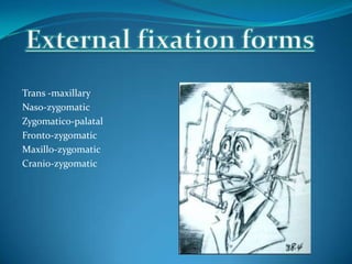 Trans -maxillary
Naso-zygomatic
Zygomatico-palatal
Fronto-zygomatic
Maxillo-zygomatic
Cranio-zygomatic
 