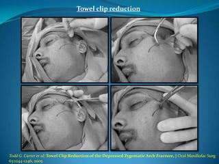 Towel clip reduction
Todd G. Carter et al; Towel Clip Reduction of the Depressed Zygomatic Arch Fracture, J Oral Maxillofac Surg
63:1244-1246, 2005
 