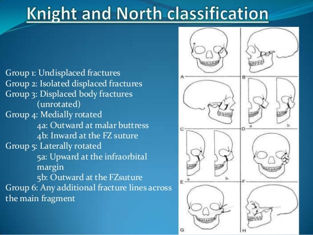 Zygomatic Fractures