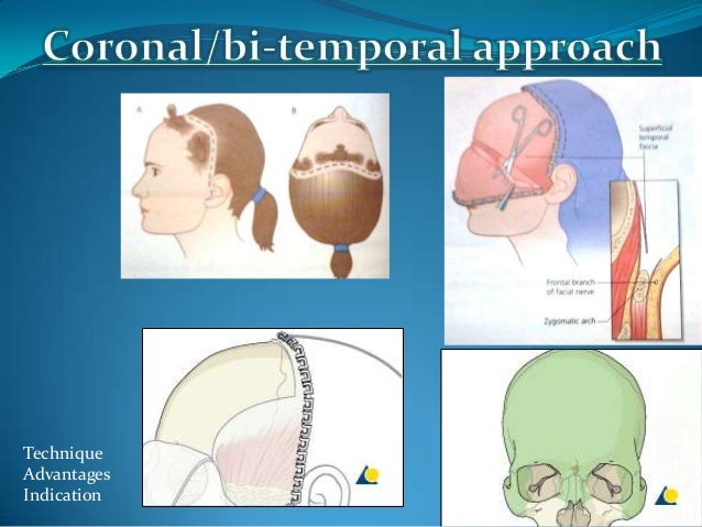 cpt code for closed reduction of zygomatic arch fracture cpt code for closed reduction of zygomatic arch fracture