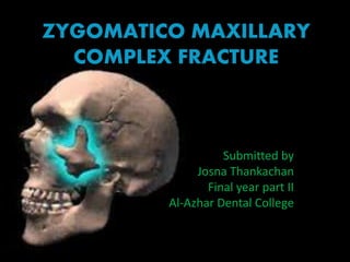 ZYGOMATICO MAXILLARY
COMPLEX FRACTURE
Submitted by
Josna Thankachan
Final year part II
Al-Azhar Dental College
 