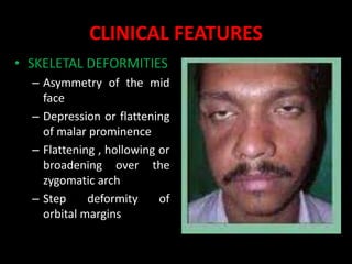 CLINICAL FEATURES
• SKELETAL DEFORMITIES
– Asymmetry of the mid
face
– Depression or flattening
of malar prominence
– Flattening , hollowing or
broadening over the
zygomatic arch
– Step deformity of
orbital margins
 