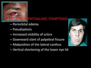 • OCULAR /OPHTHALMIC SYMPTOMS
– Periorbital edema
– Pseudoptosis
– Increased visibility of sclera
– Downward slant of palpebral fissure
– Malposition of the lateral canthus
– Vertical shortening of the lower eye lid
 