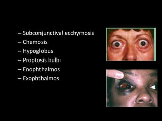 – Subconjunctival ecchymosis
– Chemosis
– Hypoglobus
– Proptosis bulbi
– Enophthalmos
– Exophthalmos
 
