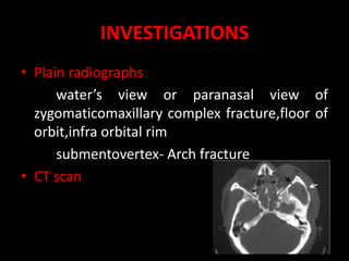 INVESTIGATIONS
• Plain radiographs
water’s view or paranasal view of
zygomaticomaxillary complex fracture,floor of
orbit,infra orbital rim
submentovertex- Arch fracture
• CT scan
 