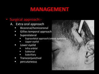 MANAGEMENT
• Surgical approach:-
A. Extra oral approach
 Bicoronal/hemicoronal
 Gillies temporal approach
 Superolateral
 Supraorbital approach;lateral eyebrow
 Upper eyelid
 Lower eyelid
 Infra orbital
 Subtarsal
 Subcilliary
 Transconjunctival
 percutaneous
 